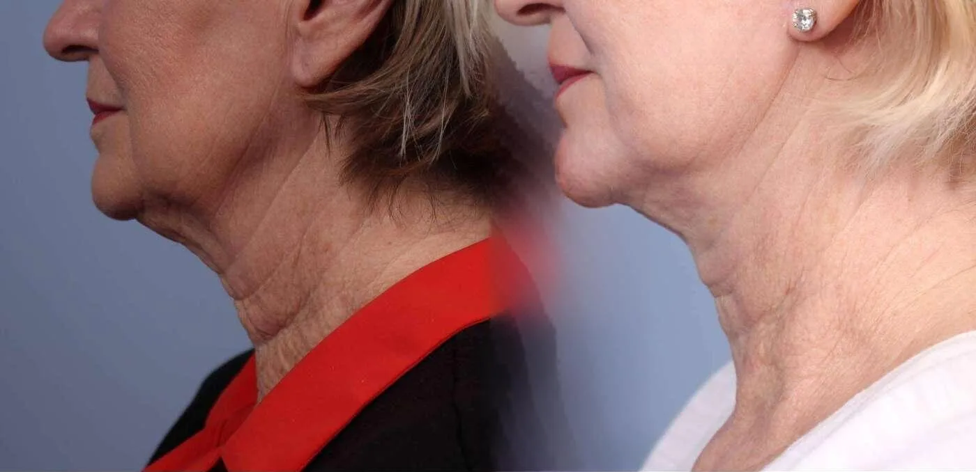 Neck Lift - Before and After Gallery - Patient Photo 87