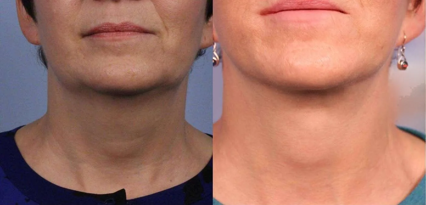 Neck Lift - Before and After Gallery - Patient Photo 88