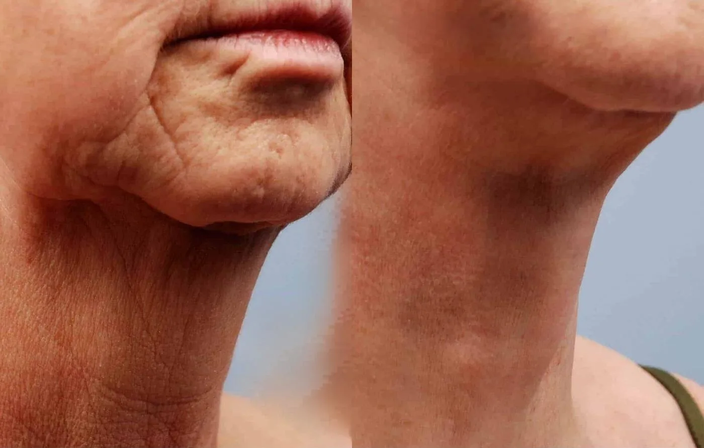 Neck Lift - Before and After Gallery - Patient Photo 9