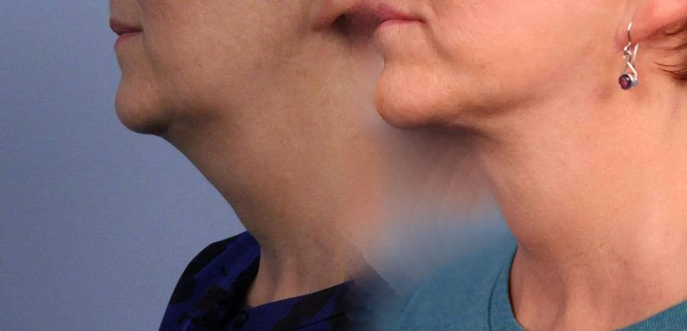 Neck Lift - Before and After Gallery - Patient Photo 90