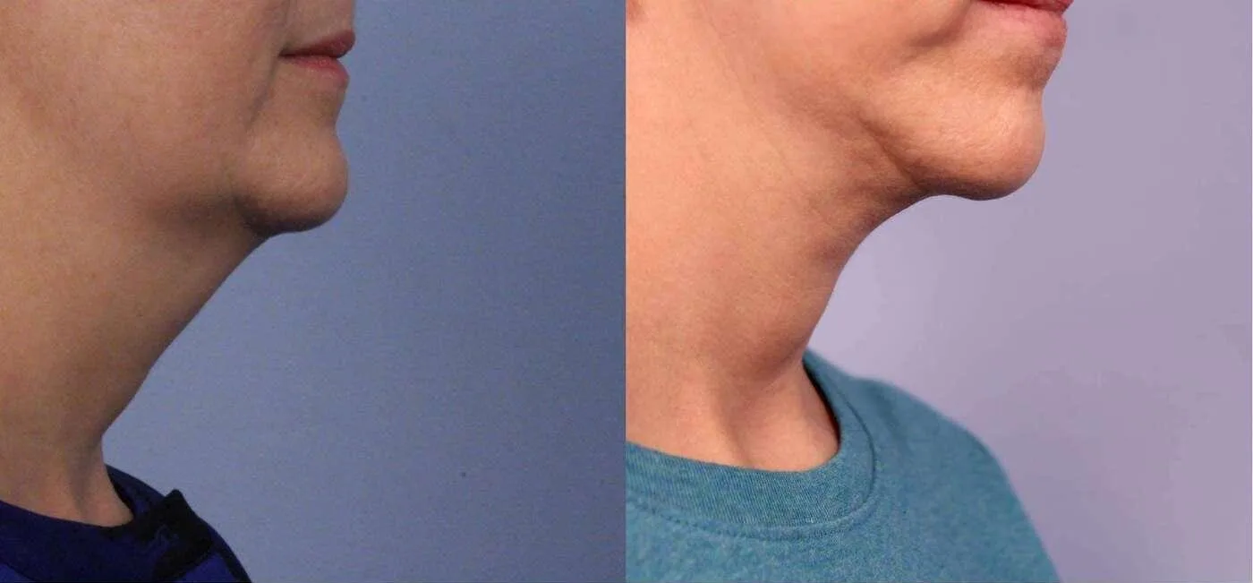 Neck Lift - Before and After Gallery - Patient Photo 92