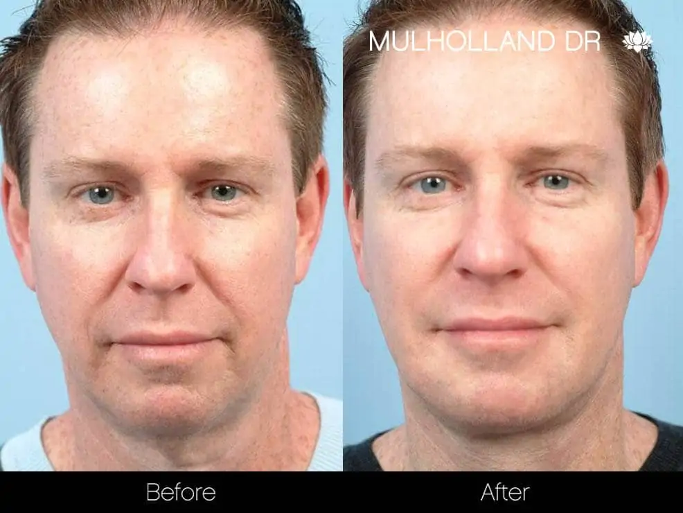 Neck Lift - Before and After Gallery - Patient Photo 95