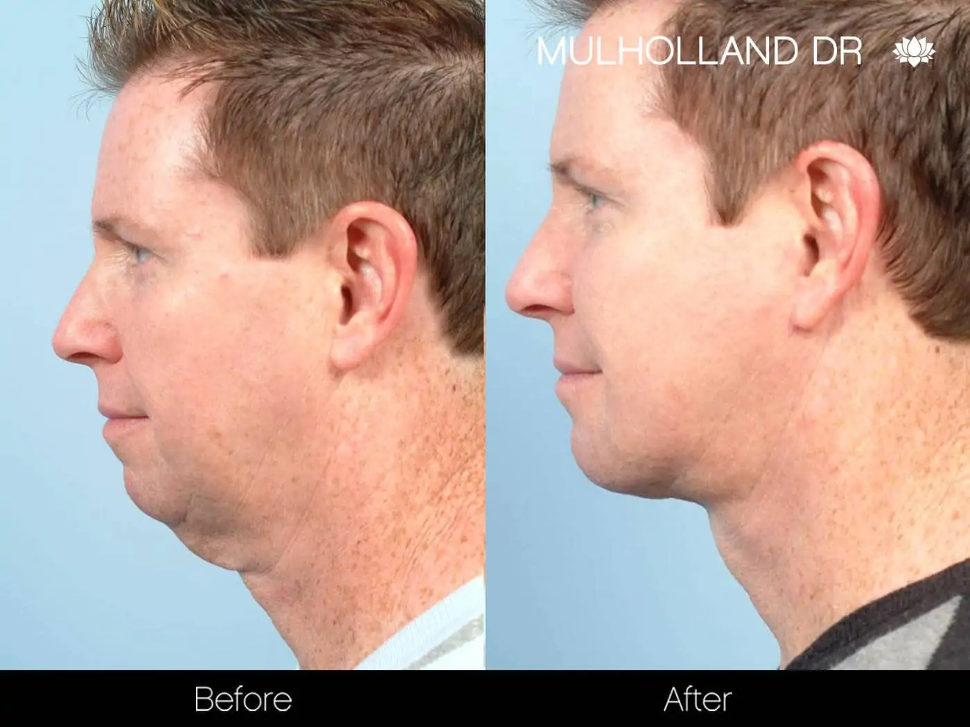 Neck Lift - Before and After Gallery - Patient Photo 96