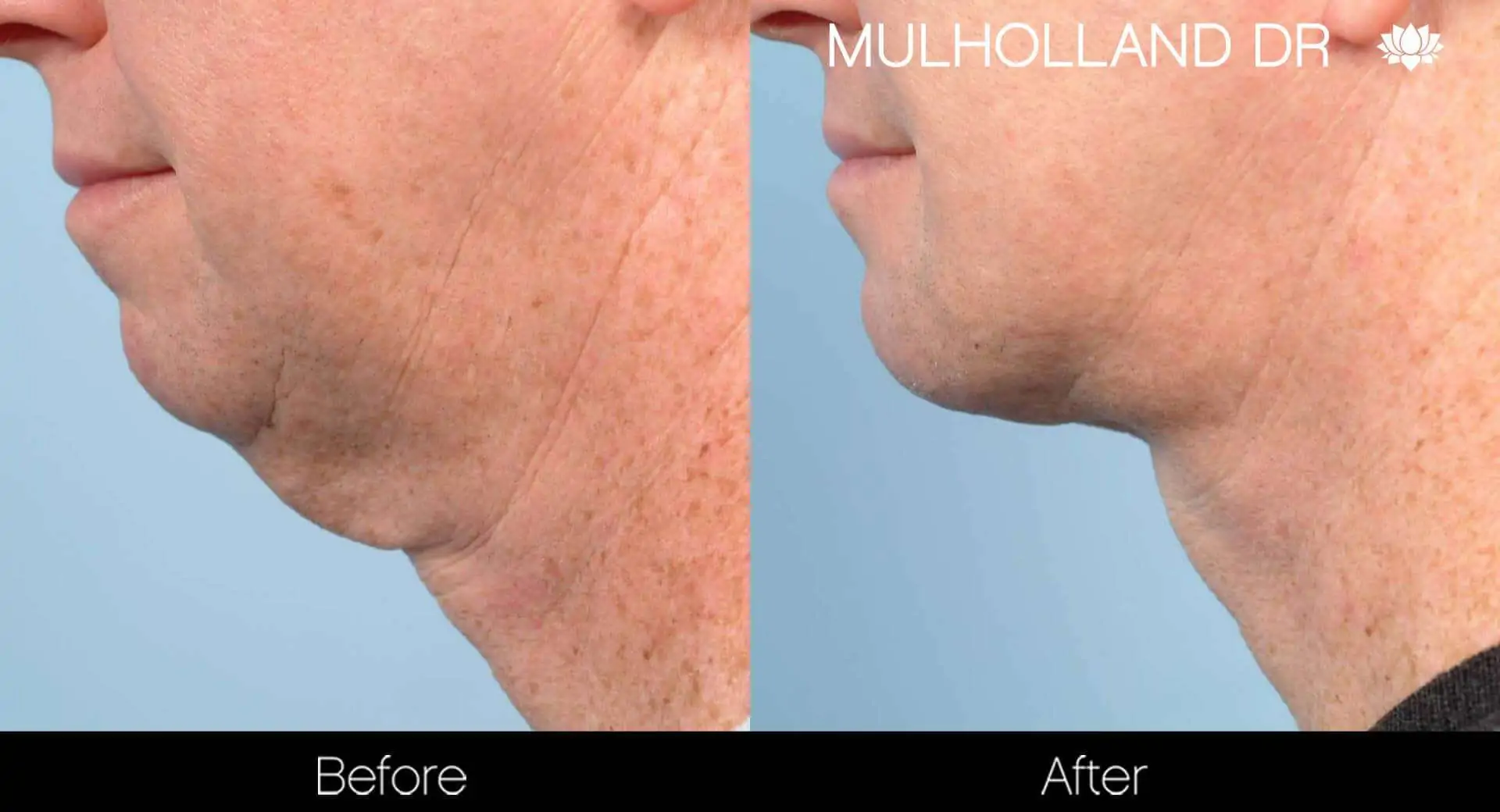 Neck Lift - Before and After Gallery - Patient Photo 97