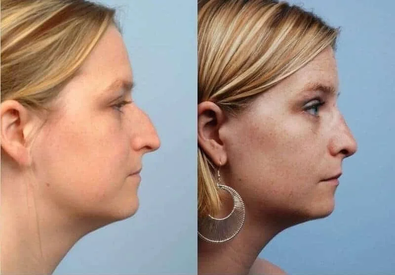 Rhinoplasty - Before and After Gallery - Patient Photo 10