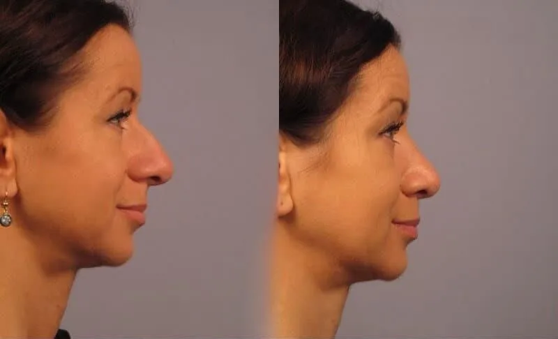 Rhinoplasty - Before and After Gallery - Patient Photo 11