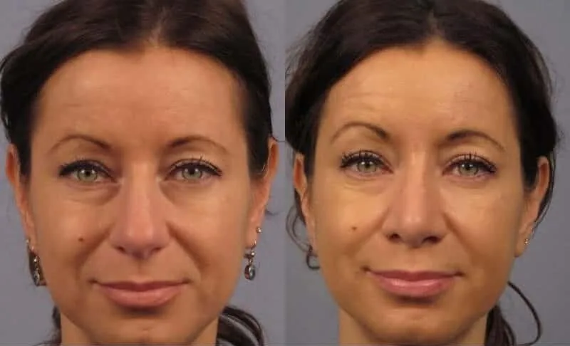 Rhinoplasty - Before and After Gallery - Patient Photo 12