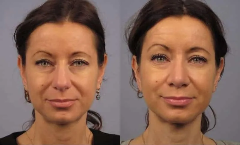 Rhinoplasty - Before and After Gallery - Patient Photo 13