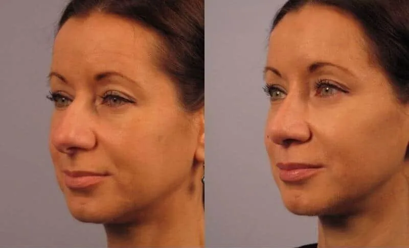 Rhinoplasty - Before and After Gallery - Patient Photo 14