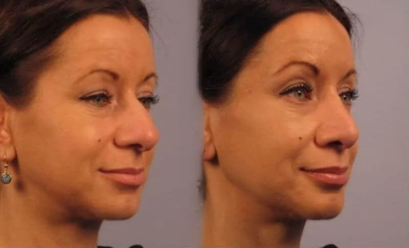 Rhinoplasty - Before and After Gallery - Patient Photo 15