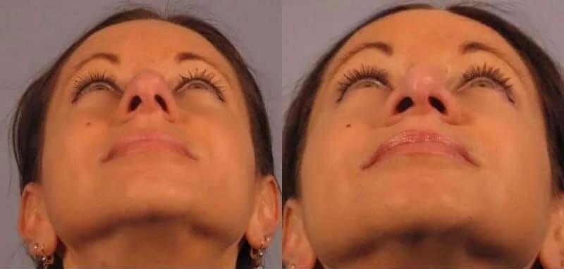 Before and after photos showing minimal to no visible scars from rhinoplasty.