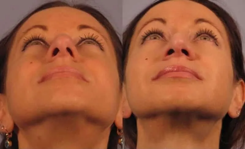 Rhinoplasty - Before and After Gallery - Patient Photo 18