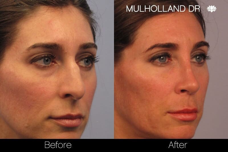 Rhinoplasty for Bulbous Nose Tip: Causes & Treatment