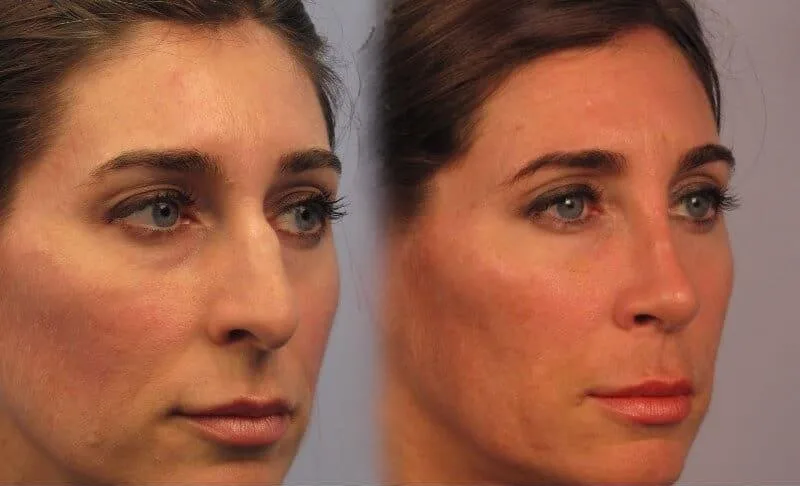 Rhinoplasty - Before and After Gallery - Patient Photo 2