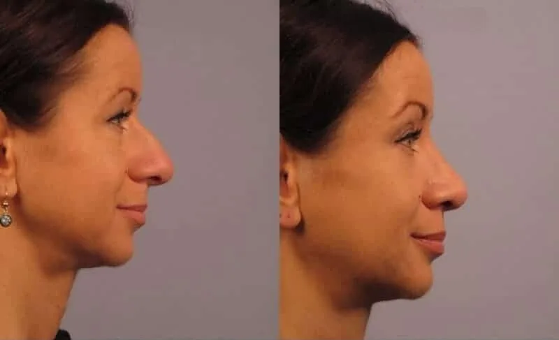 Rhinoplasty - Before and After Gallery - Patient Photo 20