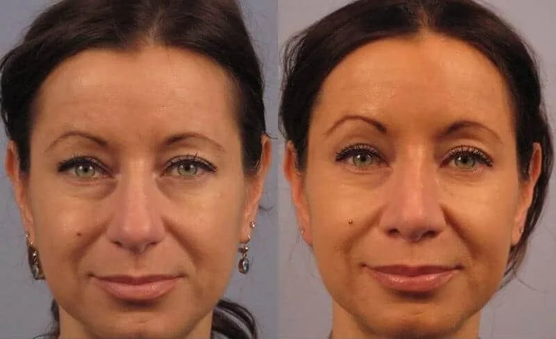 Rhinoplasty - Before and After Gallery - Patient Photo 21