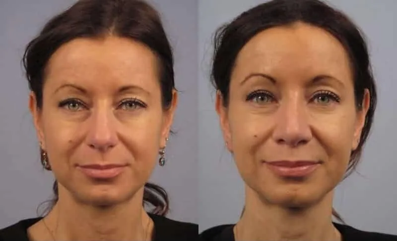 Rhinoplasty - Before and After Gallery - Patient Photo 22