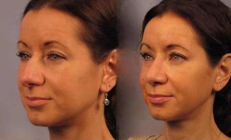 Rhinoplasty - Before and After Gallery - Patient Photo 23