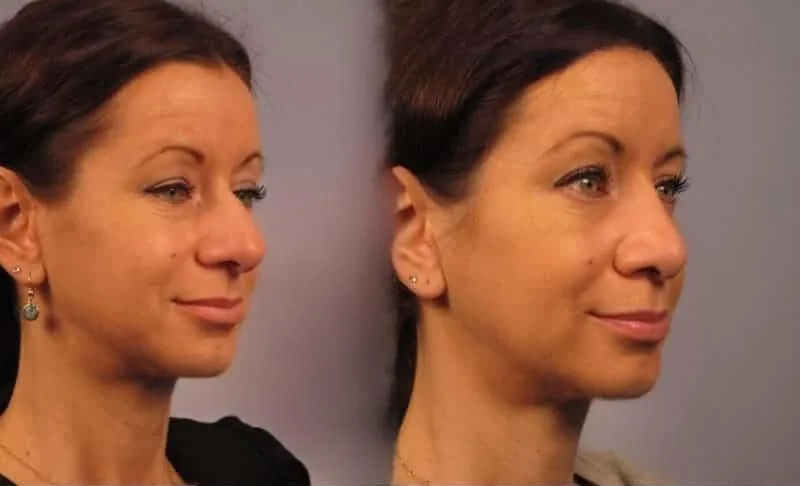 Rhinoplasty - Before and After Gallery - Patient Photo 24