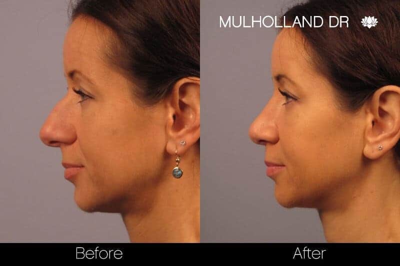 Rhinoplasty - Before and After Gallery - Patient Photo 25