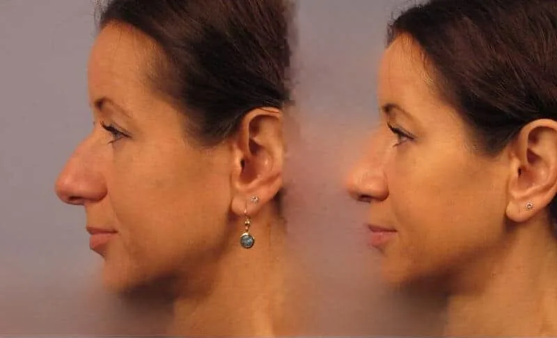 Rhinoplasty - Before and After Gallery - Patient Photo 25