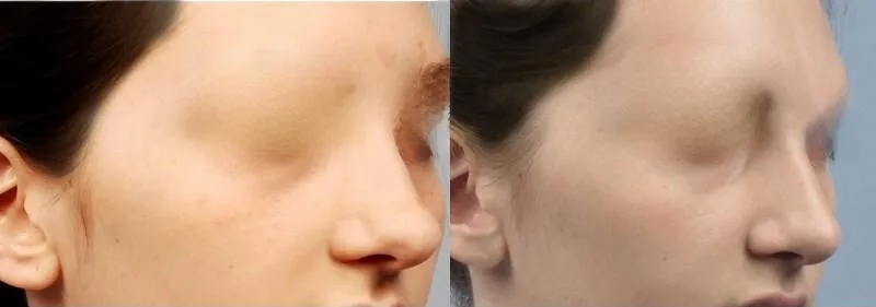 Rhinoplasty - Before and After Gallery - Patient Photo 26