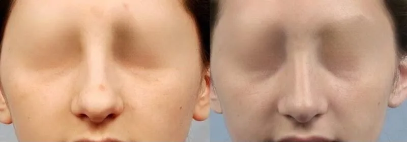 Rhinoplasty - Before and After Gallery - Patient Photo 27