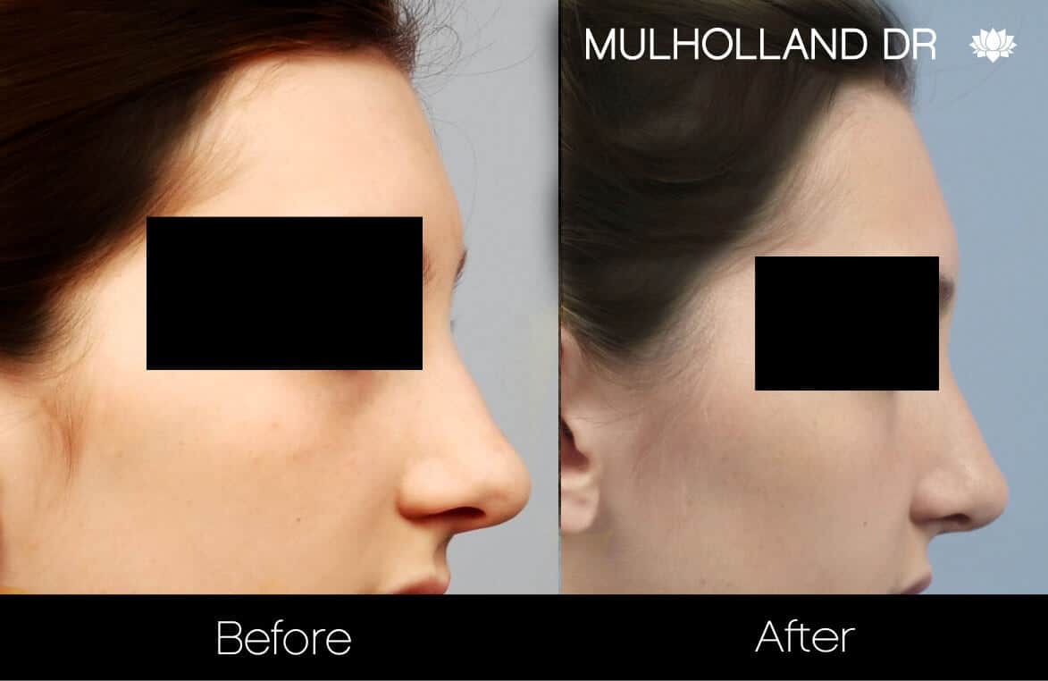 Rhinoplasty For Bulbous Nose Tip: Causes & Treatment