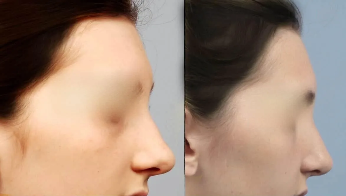 Rhinoplasty - Before and After Gallery - Patient Photo 28