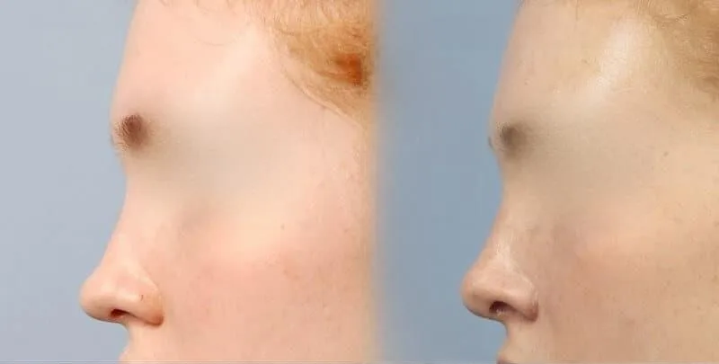 Rhinoplasty - Before and After Gallery - Patient Photo 29