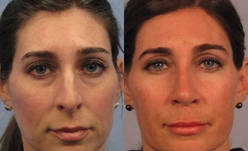 Rhinoplasty - Before and After Gallery - Patient Photo 3