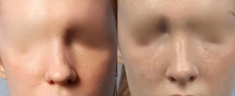 Rhinoplasty - Before and After Gallery - Patient Photo 30