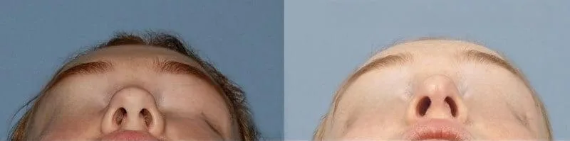 Rhinoplasty - Before and After Gallery - Patient Photo 31