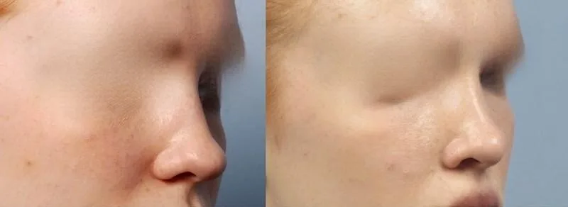 Rhinoplasty - Before and After Gallery - Patient Photo 32
