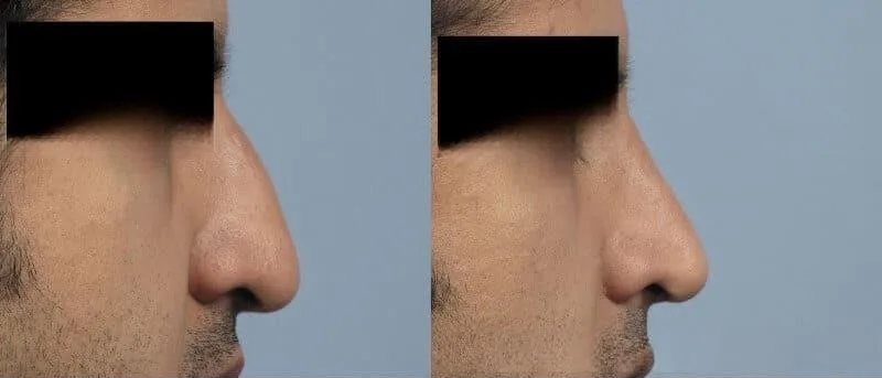 Rhinoplasty - Before and After Gallery - Patient Photo 33