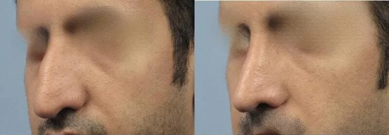 Rhinoplasty - Before and After Gallery - Patient Photo 34