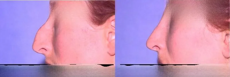 Rhinoplasty - Before and After Gallery - Patient Photo 35