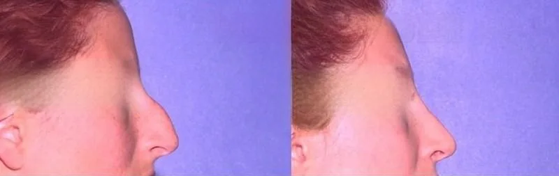 Rhinoplasty - Before and After Gallery - Patient Photo 36