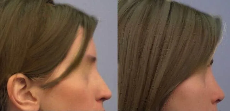 Rhinoplasty - Before and After Gallery - Patient Photo 37