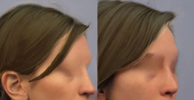 Rhinoplasty - Before and After Gallery - Patient Photo 38