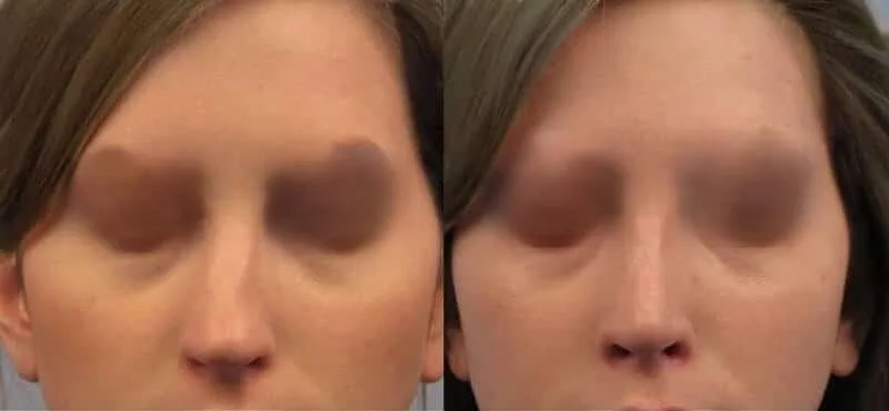 Rhinoplasty - Before and After Gallery - Patient Photo 39