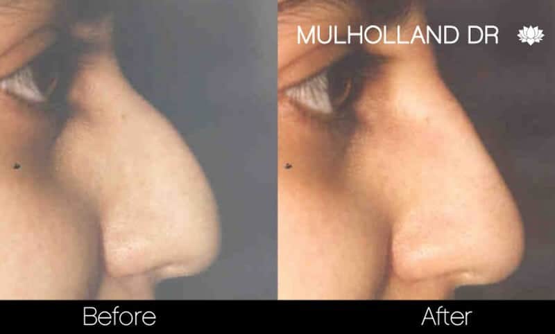 Rhinoplasty - Before and After Gallery - Patient Photo 40