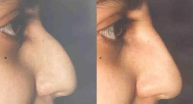 Rhinoplasty - Before and After Gallery - Patient Photo 40
