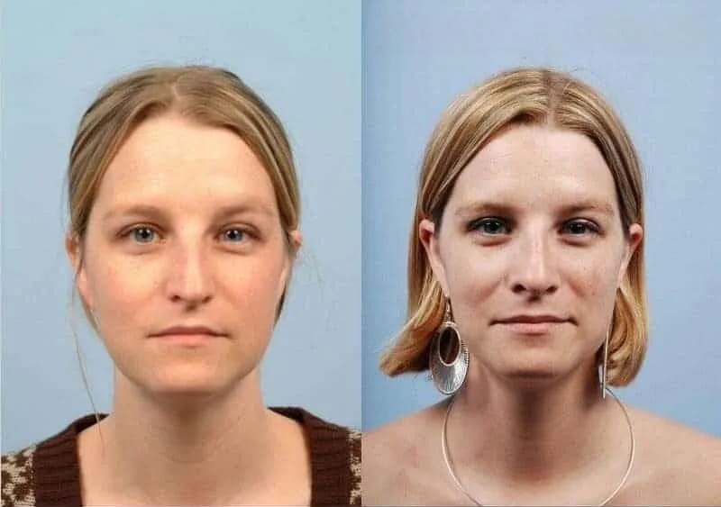Rhinoplasty - Before and After Gallery - Patient Photo 5