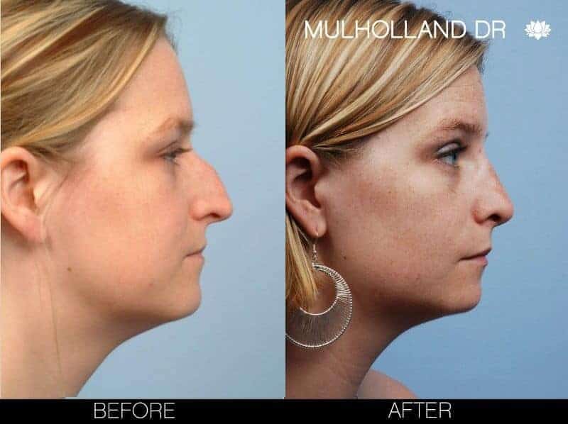 Rhinoplasty - Before and After Gallery - Patient Photo 6