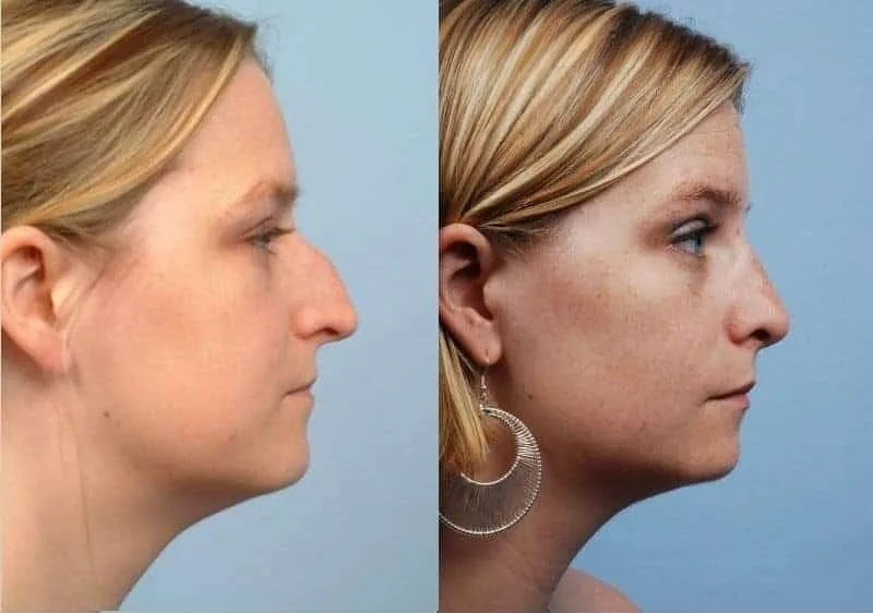 Rhinoplasty - Before and After Gallery - Patient Photo 6