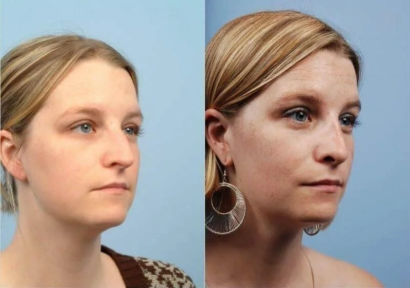 Rhinoplasty - Before and After Gallery - Patient Photo 7