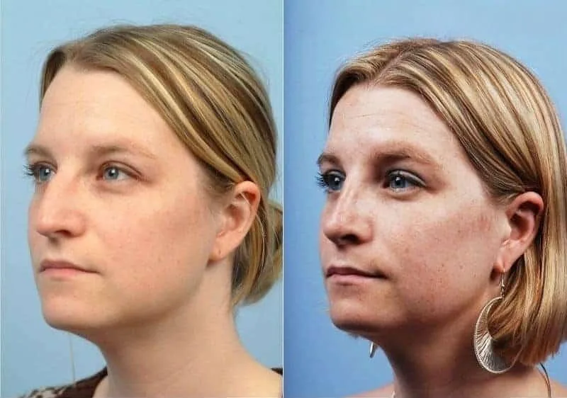 Rhinoplasty - Before and After Gallery - Patient Photo 8