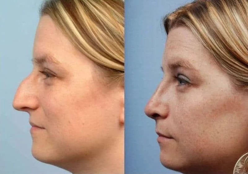 Rhinoplasty - Before and After Gallery - Patient Photo 9