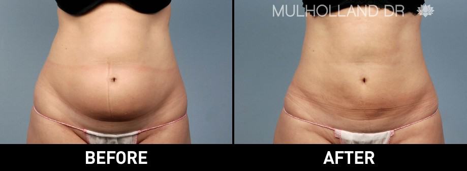 SmartLipo - Before and After Gallery - Patient Photo 22